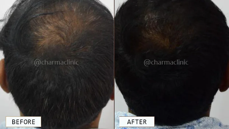 Hair Loss Treatment Before and After - Results