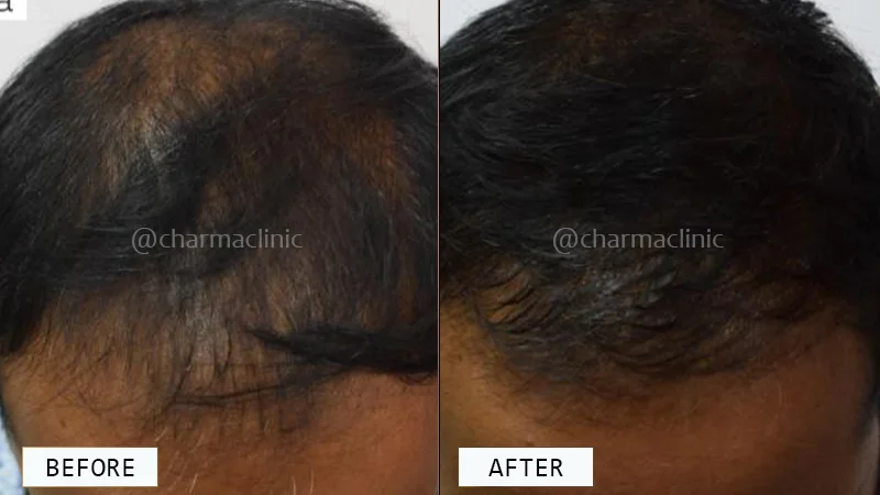 Hair Loss Treatment Before and After - Results