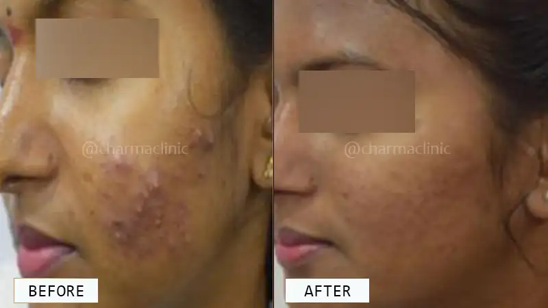 Acne Laser Treatment Before and After