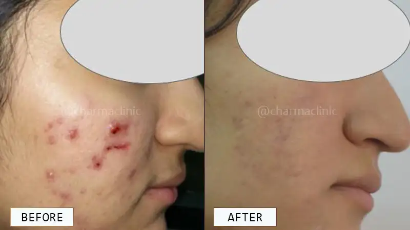 Acne Treatment Before and After